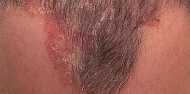Kopfhaut urea schuppenflechte III▷ Die